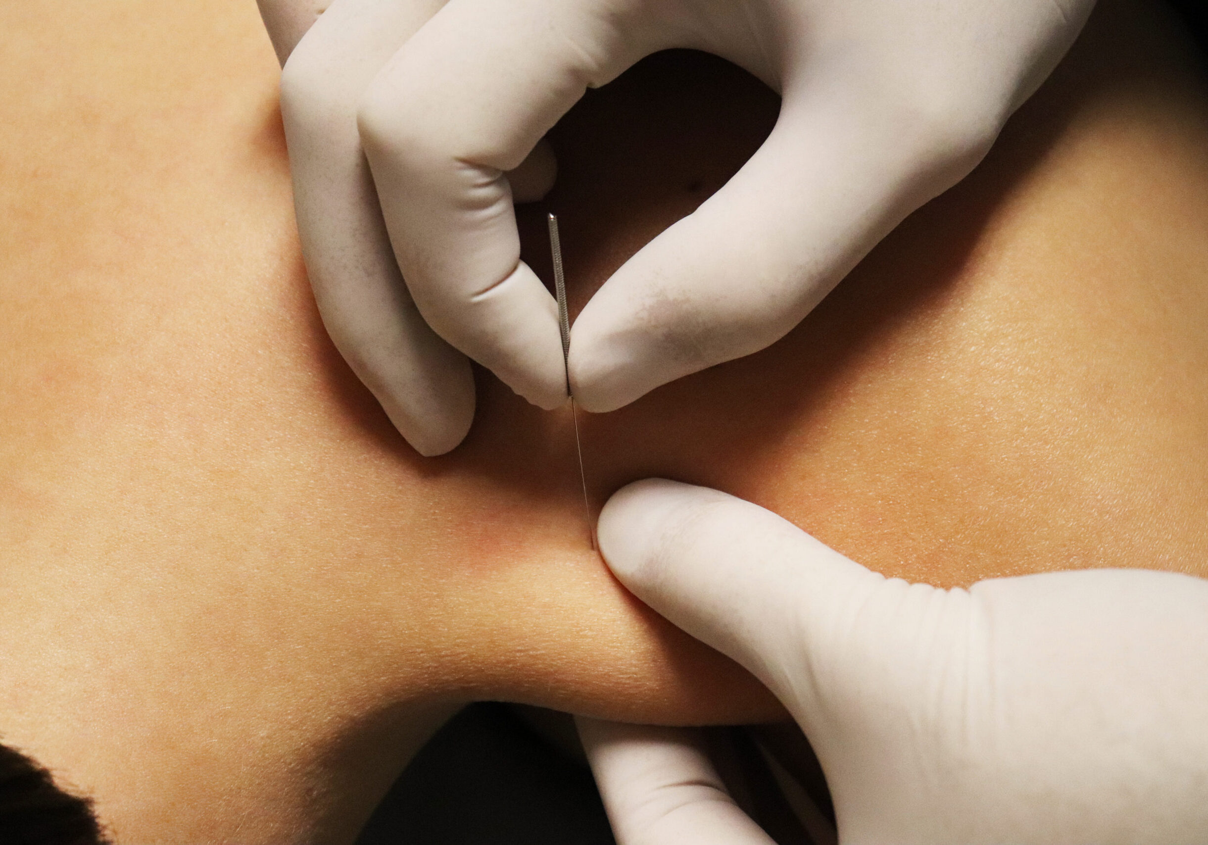 Closeup,Of,Dry,Needling,Technique,In,The,Upper,Trapezius.