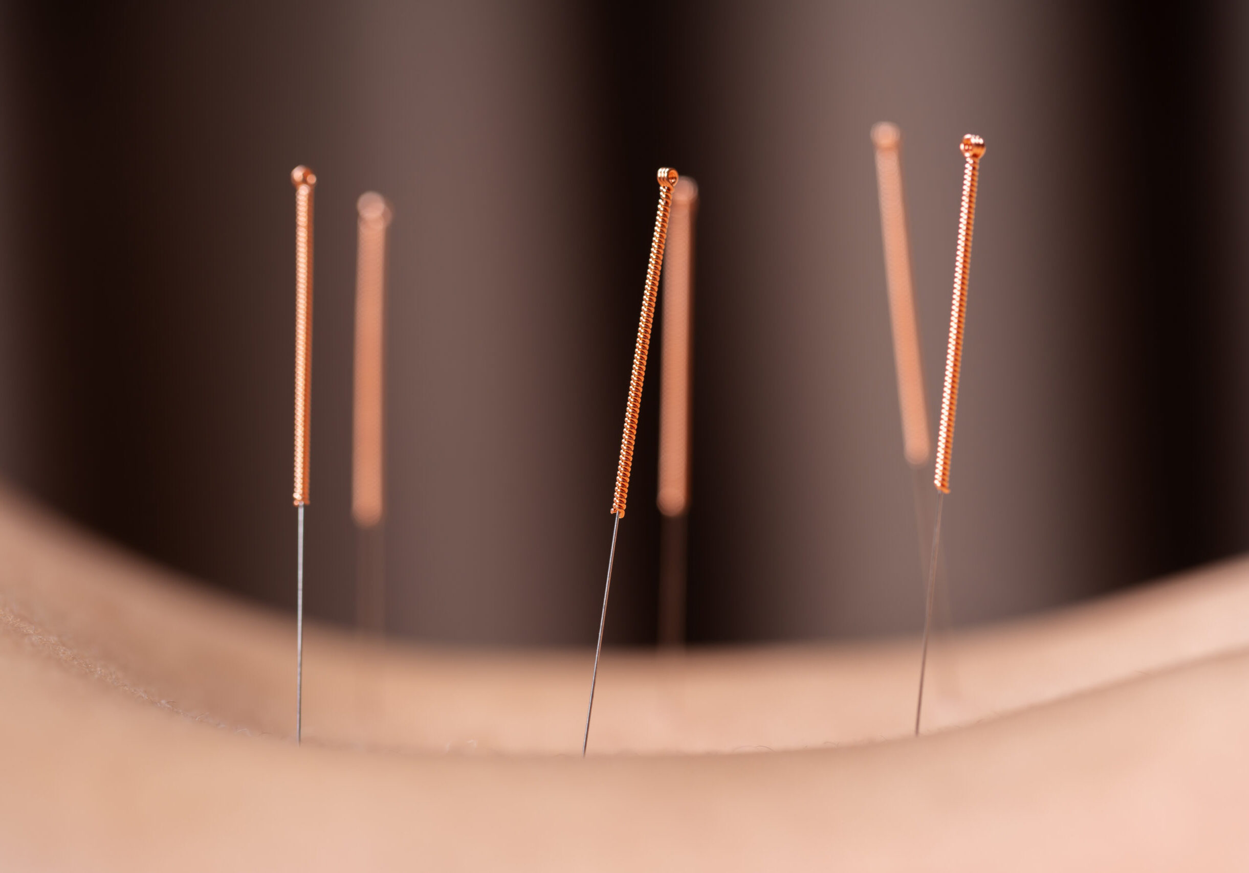 Close,Up,Woman,Undergoing,Acupuncture,Treatment,On,Back